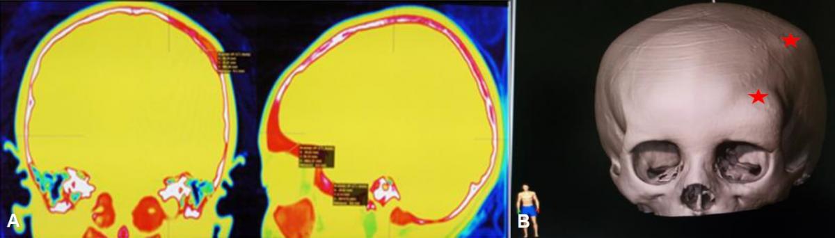 McCune Albright Syndrome Craniofacial Manifestations And Surgical